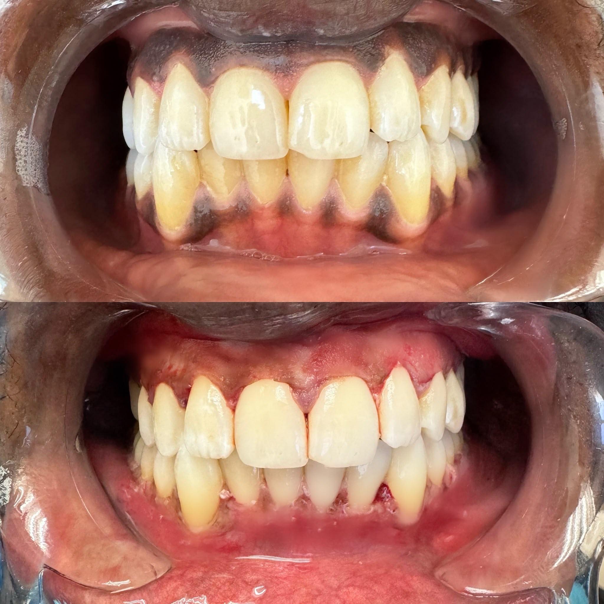 Laser gum lightening — before and after, a Sterling patient