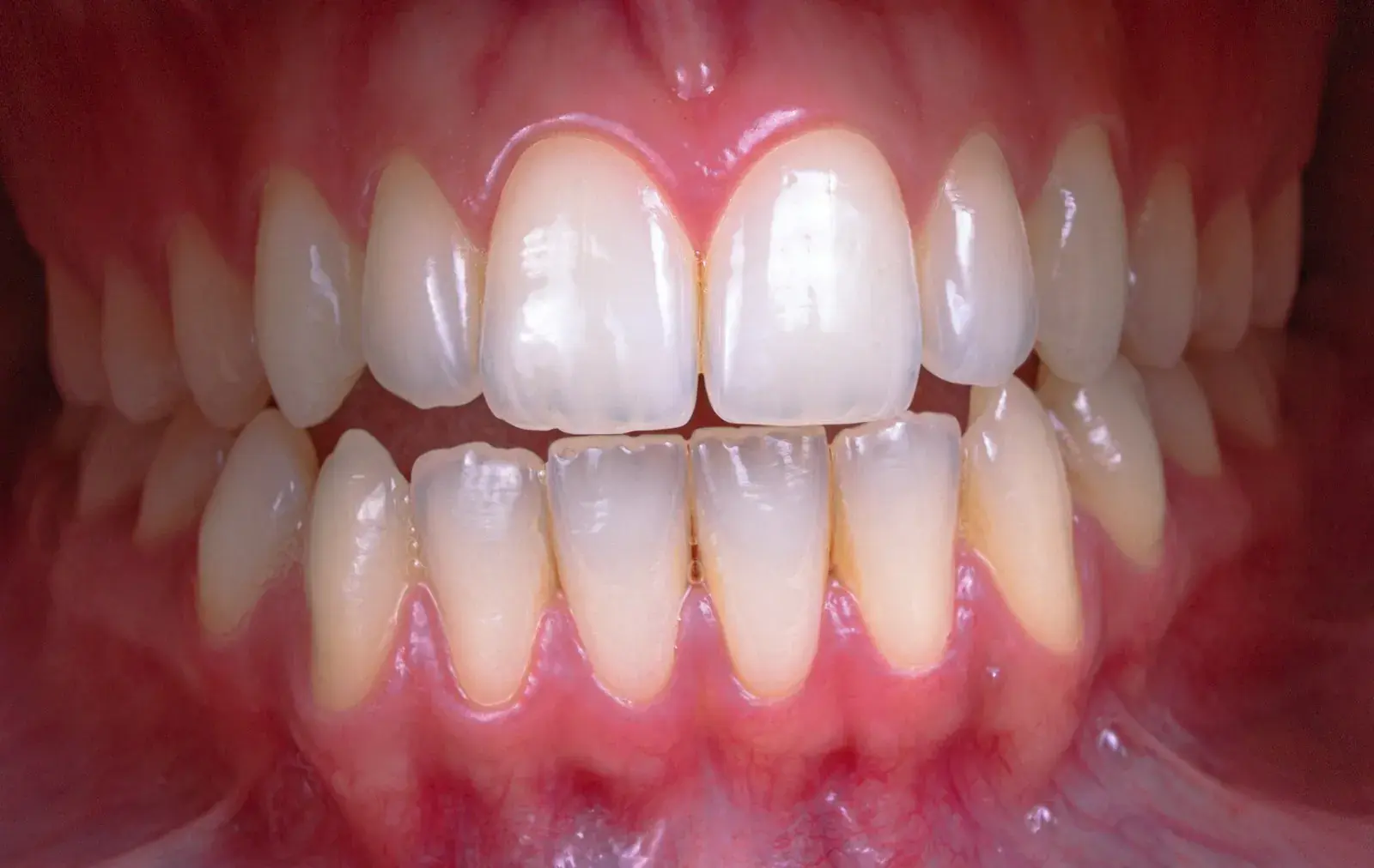 Close-up of a healthy gumline
